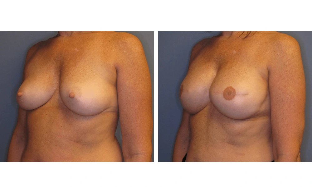 Breast Reconstruction - Case 2 (3)