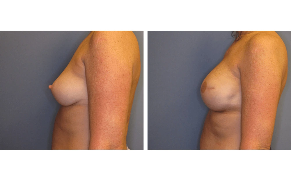 Breast Reconstruction - Case 2 (4)