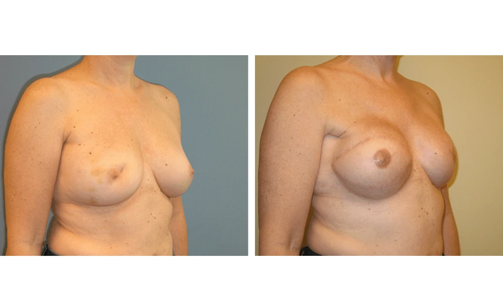 Breast Reconstruction - Case 3 (1)