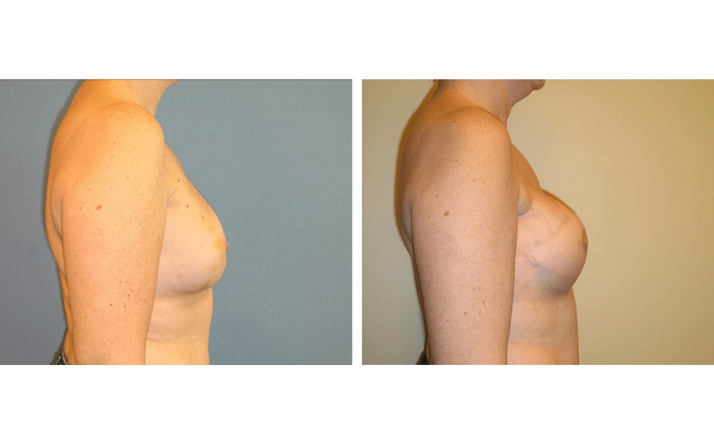 Breast Reconstruction - Case 3 (2)