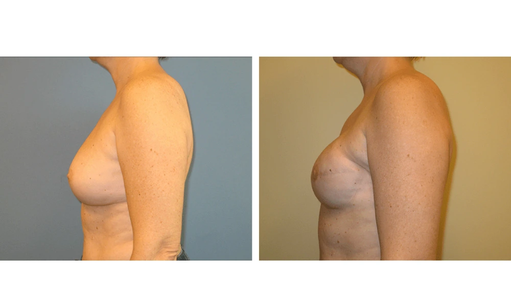 Breast Reconstruction - Case 3 (5)
