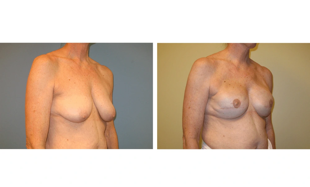 Breast Reconstruction - Case 4 (1)