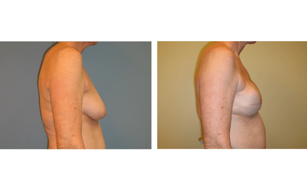 Breast Reconstruction - Case 4 (2)