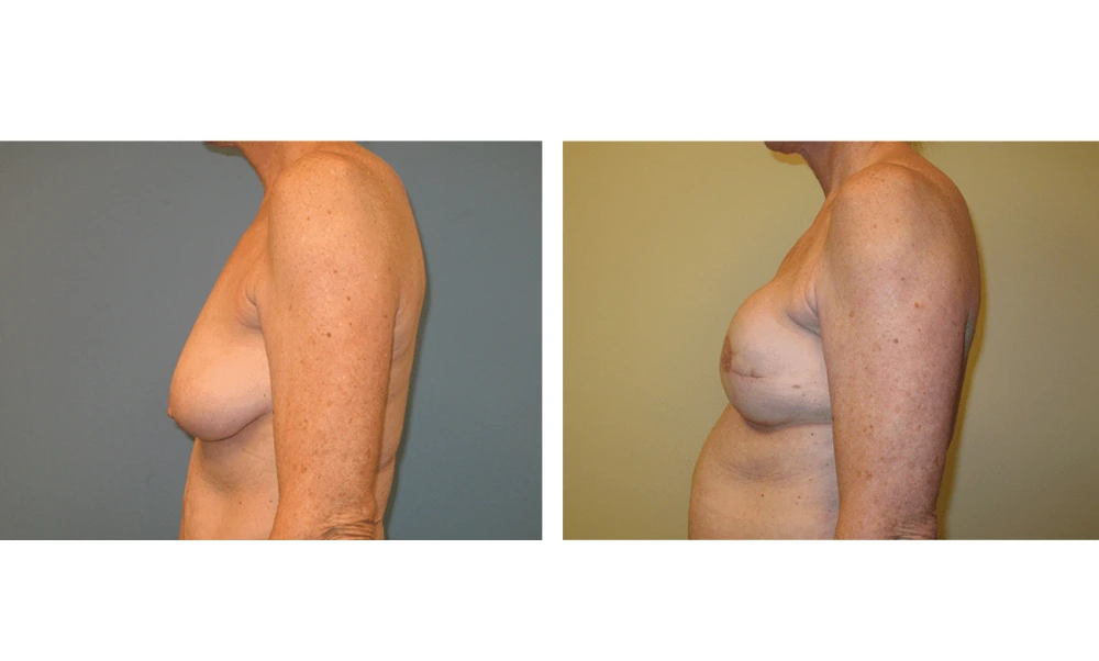 Breast Reconstruction - Case 4 (3)