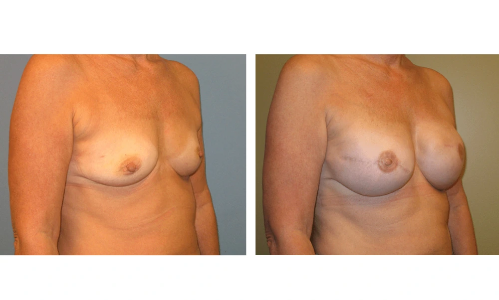 Breast Reconstruction - Case 5 (1)