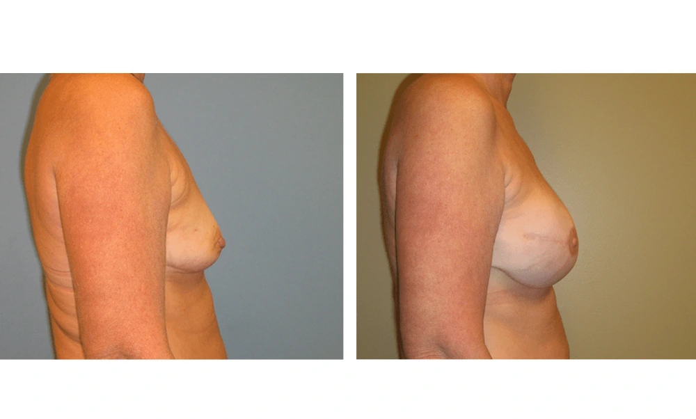 Breast Reconstruction - Case 5 (2)