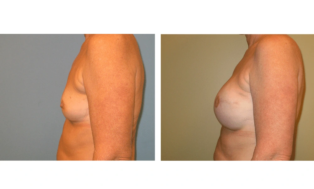 Breast Reconstruction - Case 5 (4)