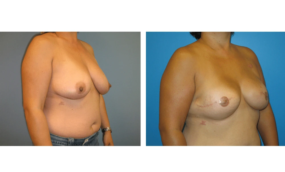 Breast Reconstruction - Case 6 (1)
