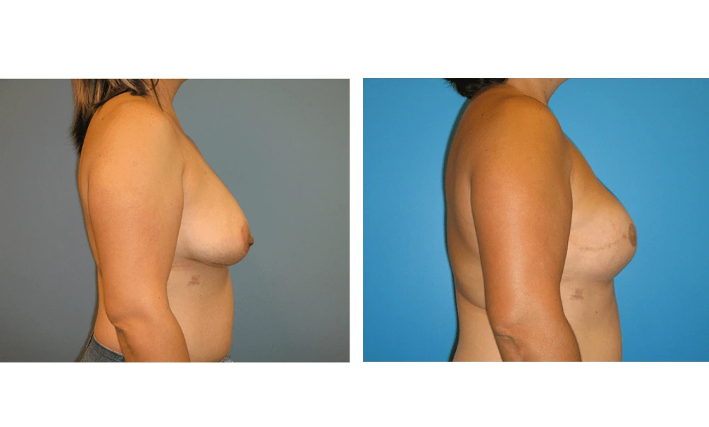 Breast Reconstruction - Case 6 (2)