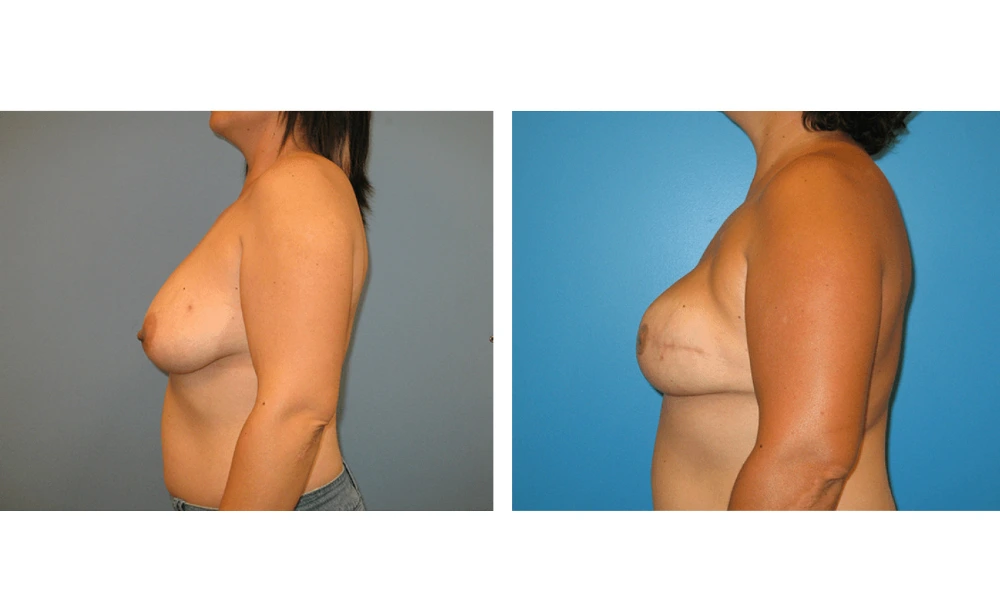 Breast Reconstruction - Case 6 (3)