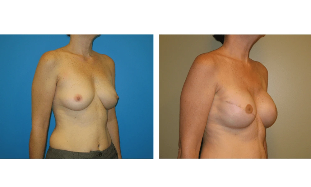 Breast Reconstruction - Case 7 (1)
