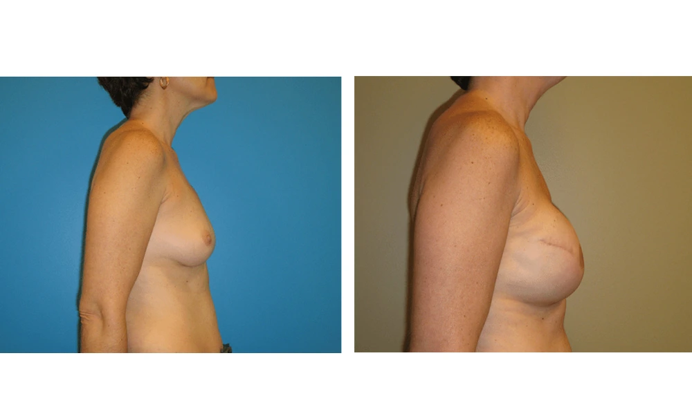 Breast Reconstruction - Case 7 (2)