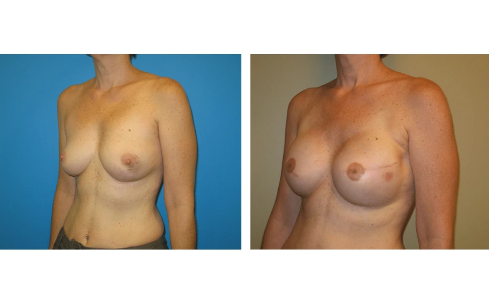 Breast Reconstruction - Case 7 (3)