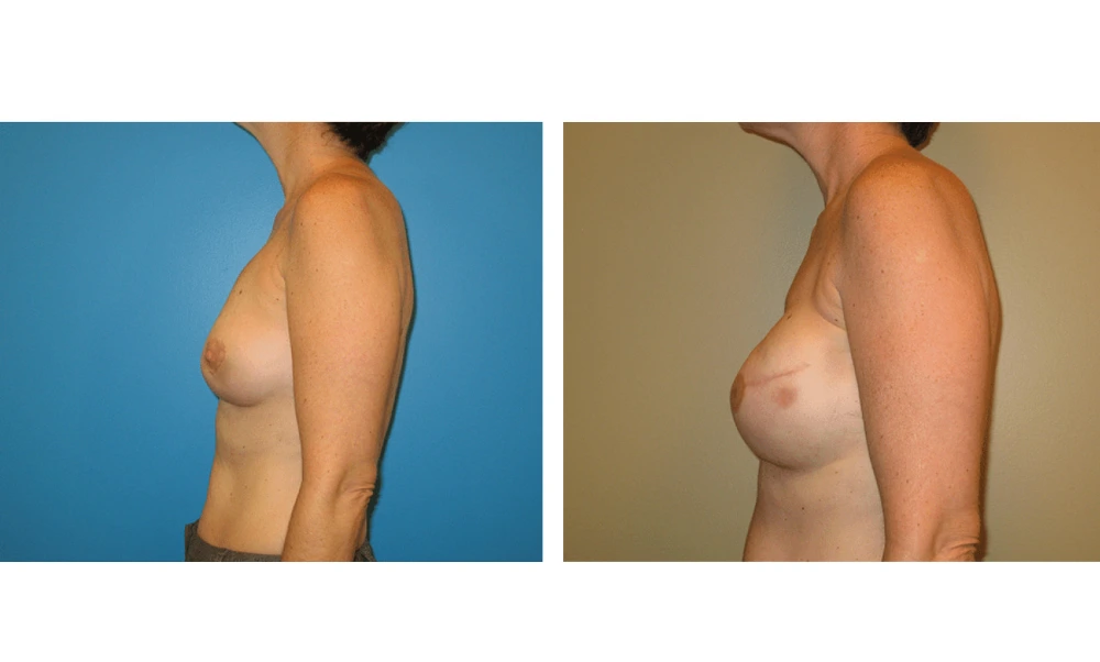 Breast Reconstruction - Case 7 (4)