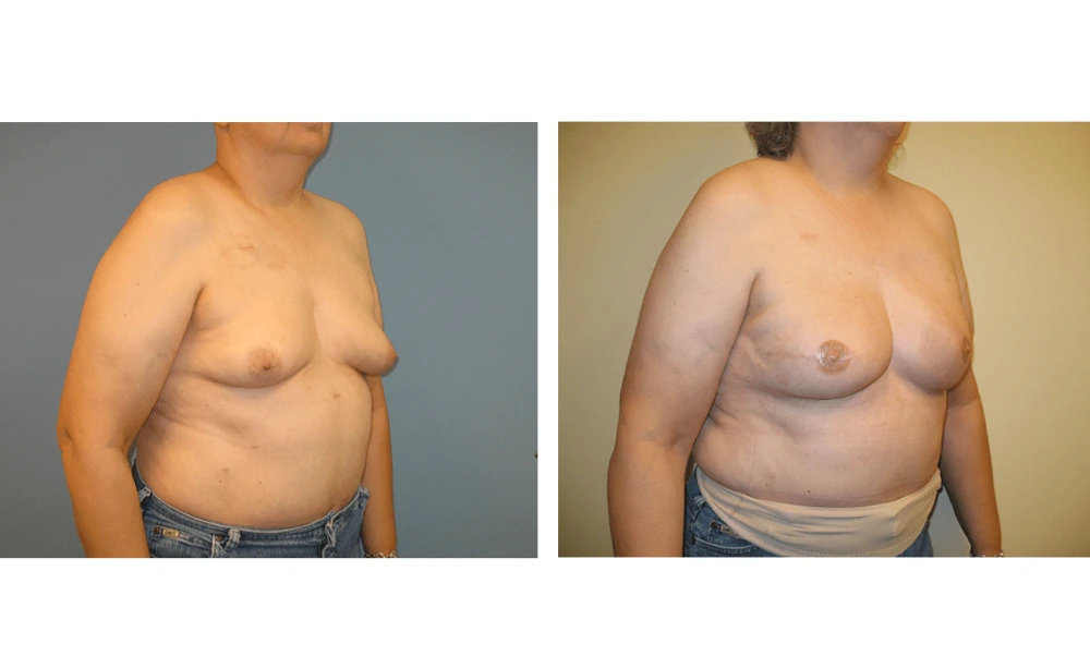 Breast Reconstruction - Case 8 (1)