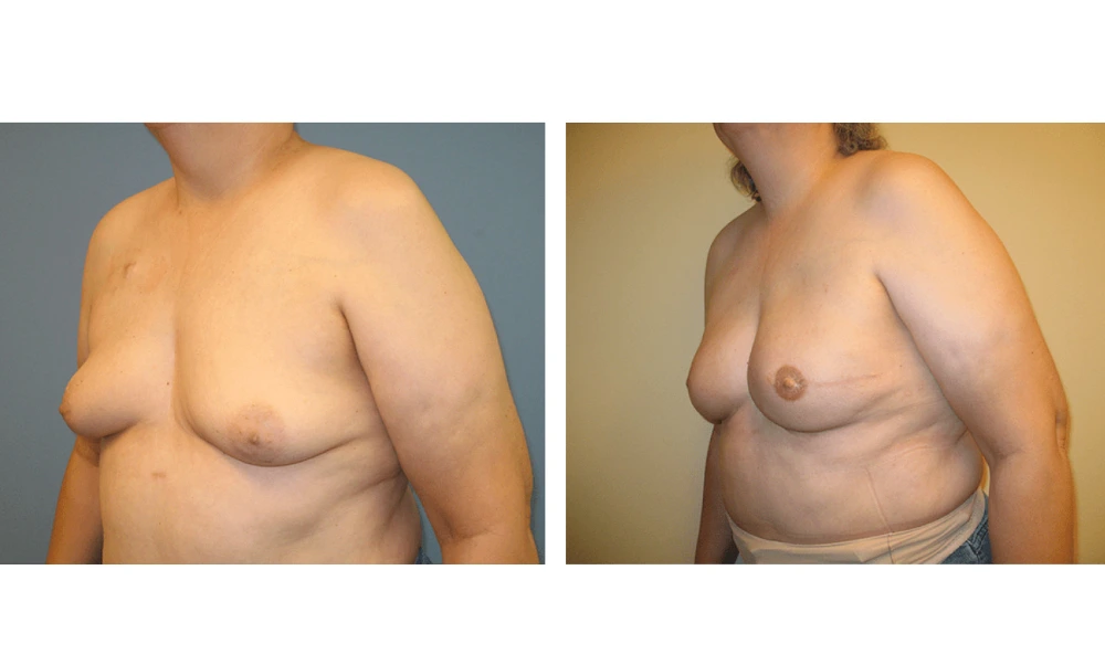 Breast Reconstruction - Case 8 (3)