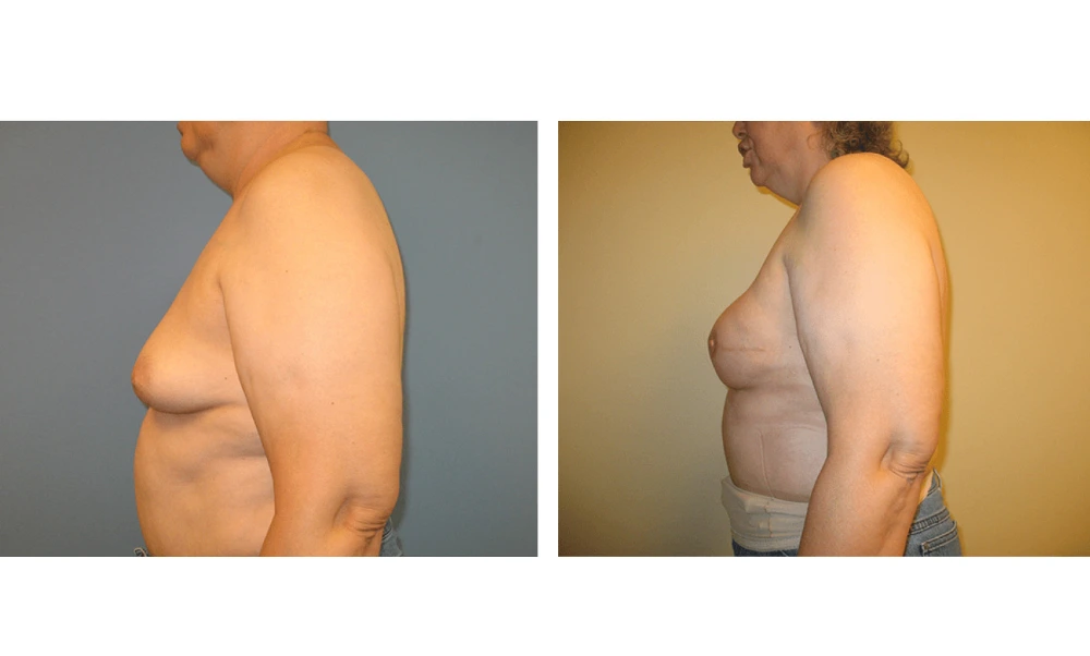 Breast Reconstruction - Case 8 (4)