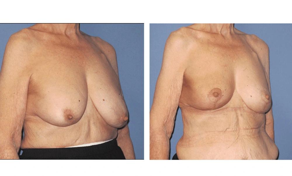 Breast Reconstruction - Case 9 (1)