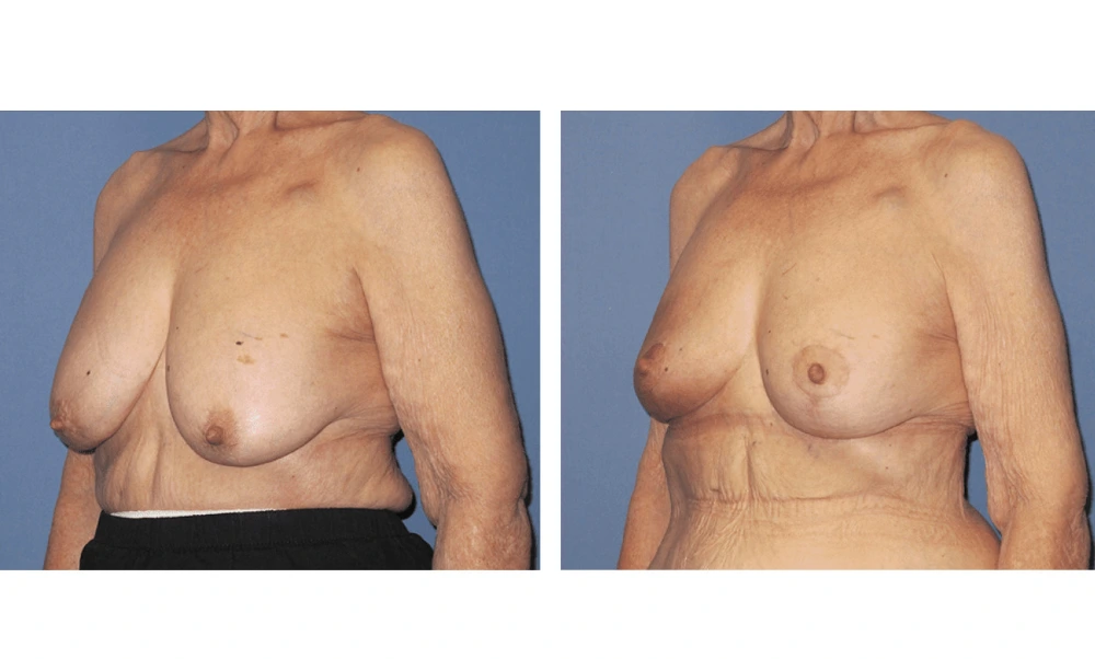 Breast Reconstruction - Case 9 (2)