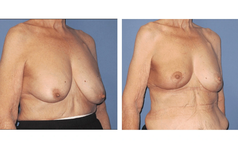 Breast Reconstruction - Case 9 (3)