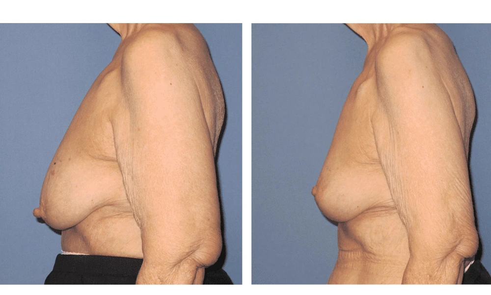 Breast Reconstruction - Case 9 (4)