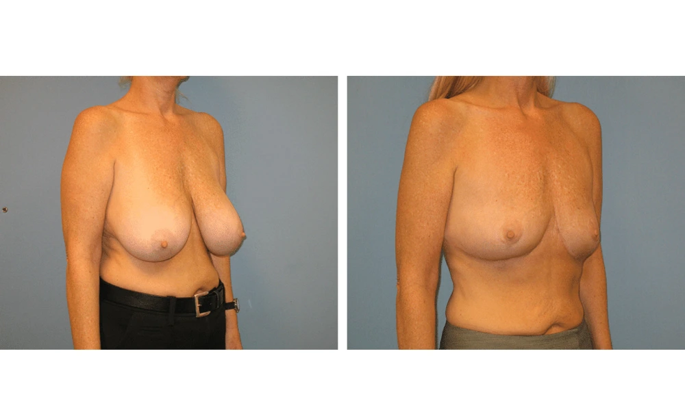 Breast Reduction - Case 1 (1)