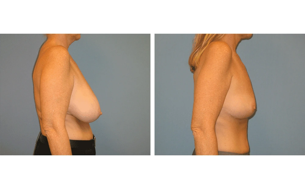 Breast Reduction - Case 1 (2)