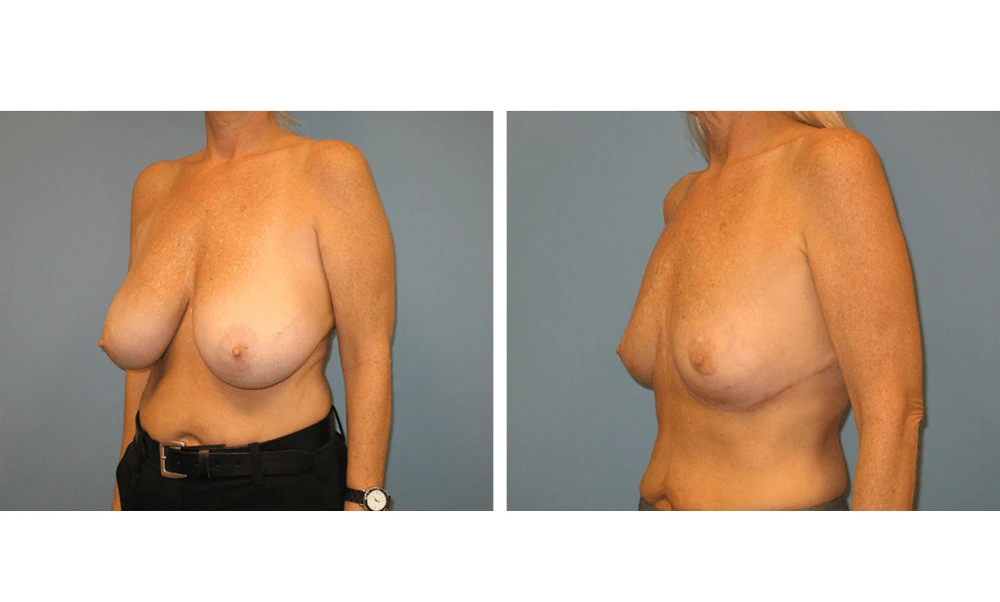 Breast Reduction - Case 1 (3)