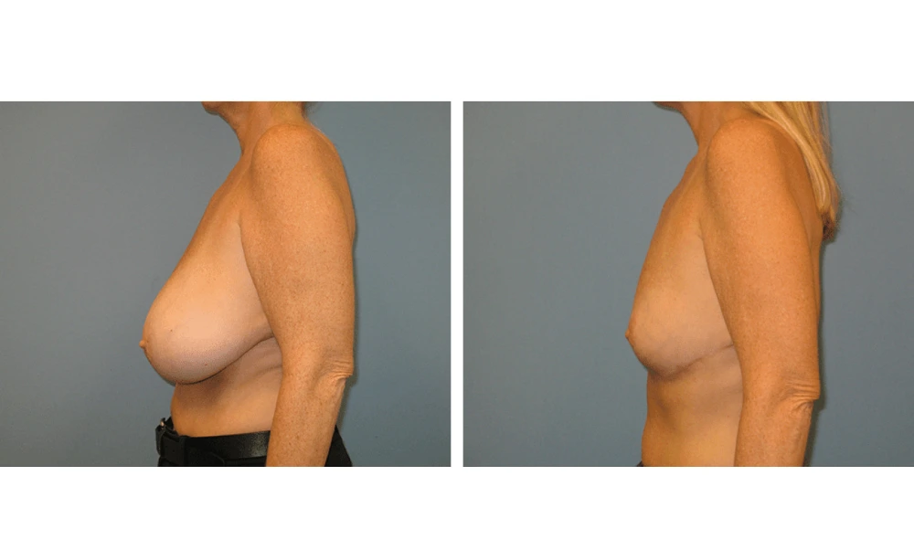 Breast Reduction - Case 1 (4)