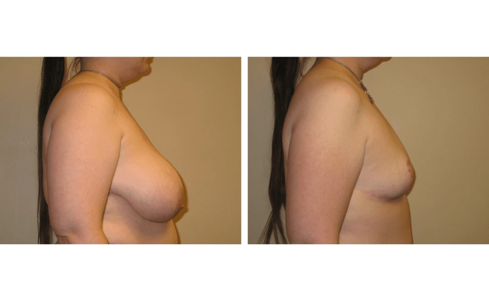 Breast Reduction - Case 2 (2)