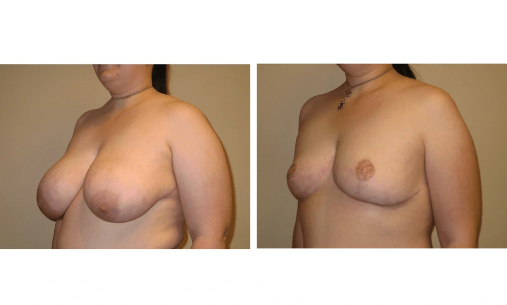 Breast Reduction - Case 2 (3)