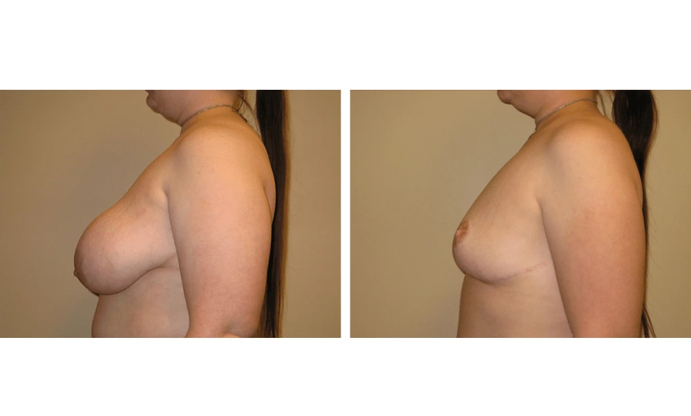 Breast Reduction - Case 2 (4)