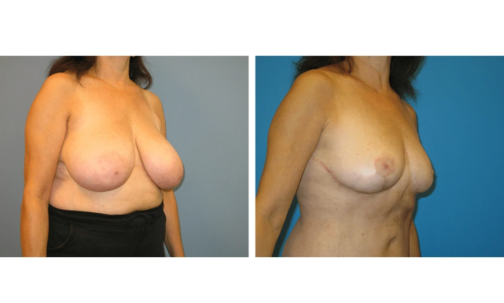 Breast Reduction - Case 3 (1)