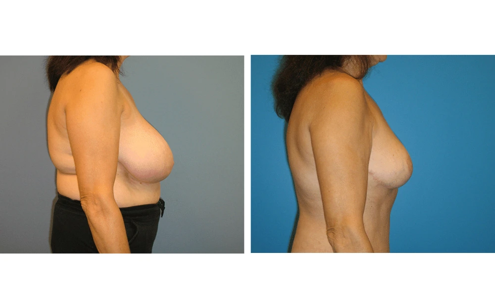 Breast Reduction - Case 3 (2)