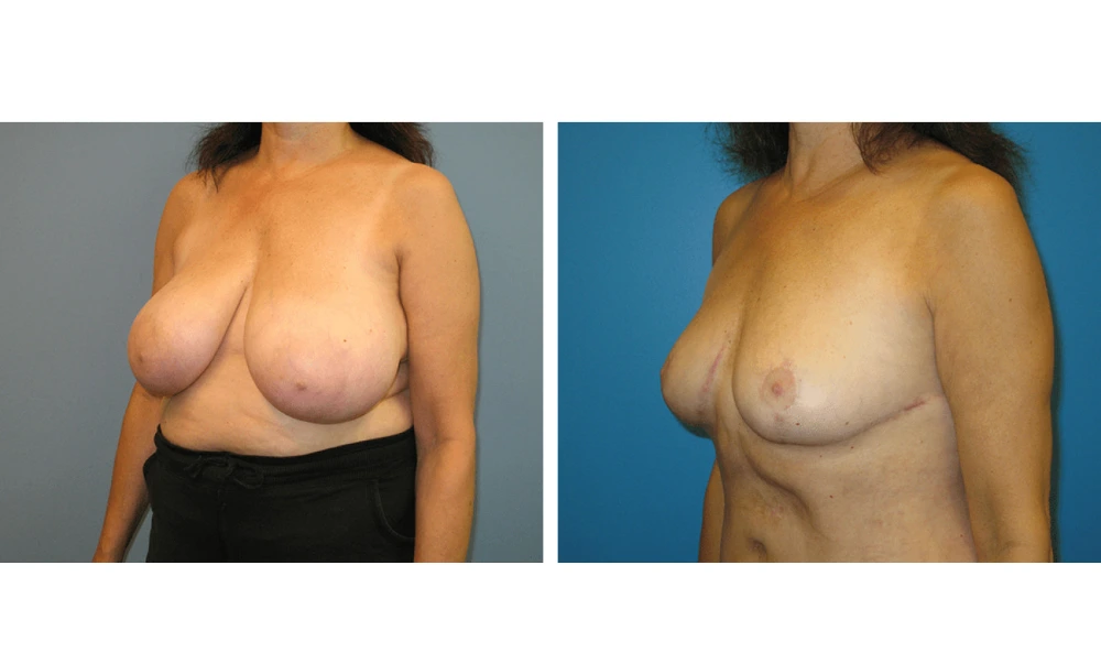 Breast Reduction - Case 3 (3)