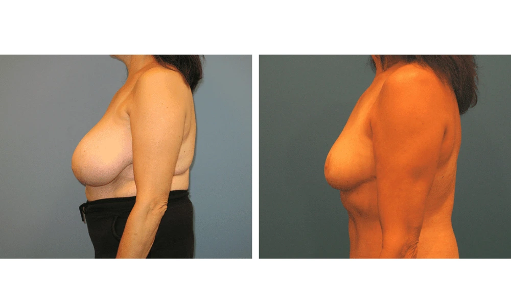 Breast Reduction - Case 3 (4)