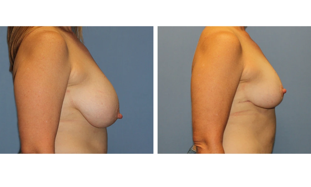 Breast Reduction - Case 4 (1)