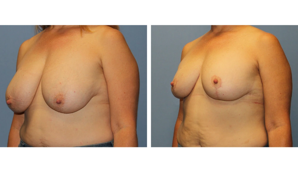 Breast Reduction - Case 4 (2)