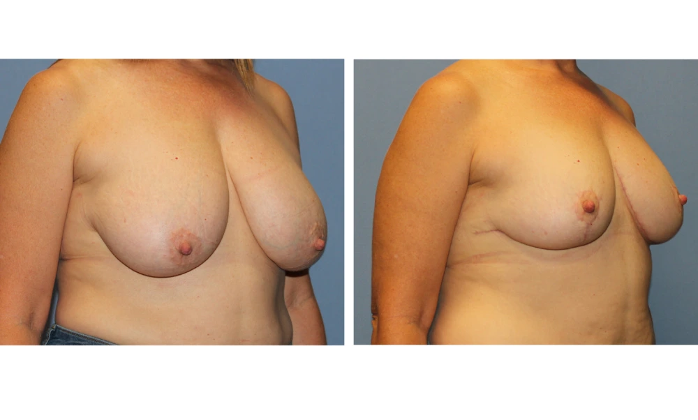 Breast Reduction - Case 4 (4)