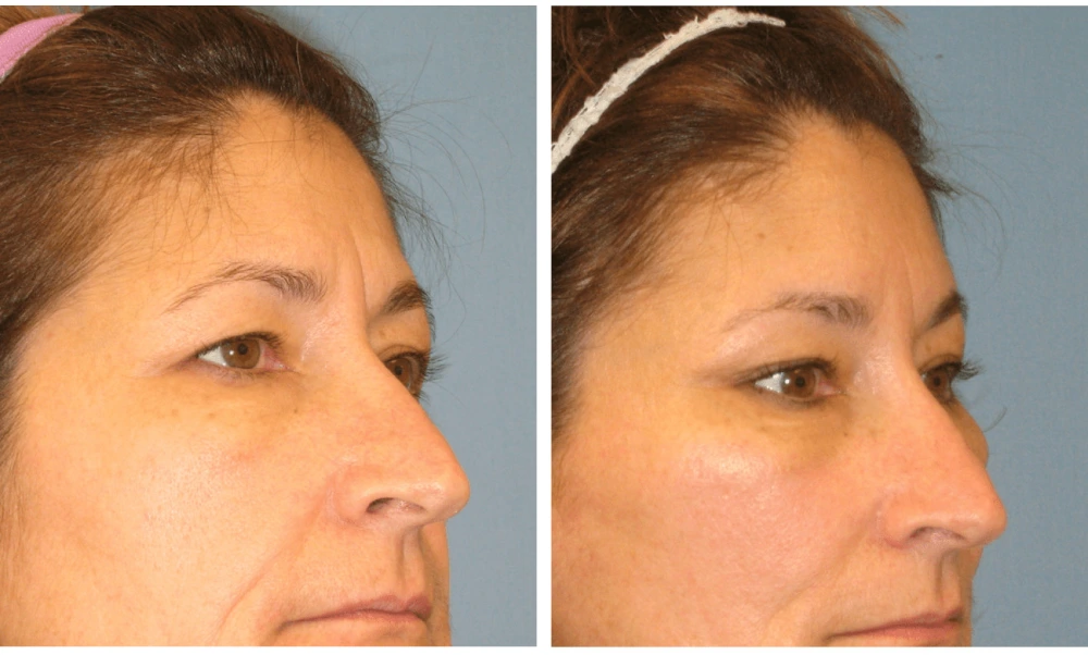 Brow Lift - Case 1 (2)
