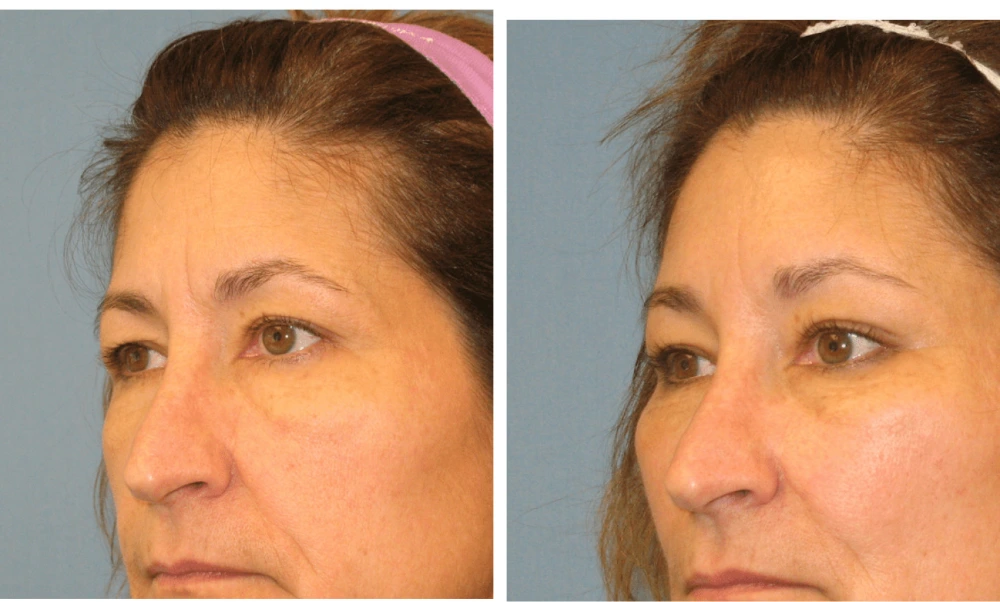 Brow Lift - Case 1 (4)