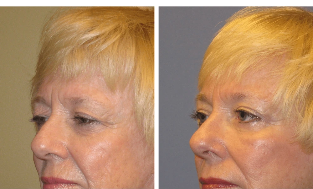 Brow Lift - Case 2 (2)