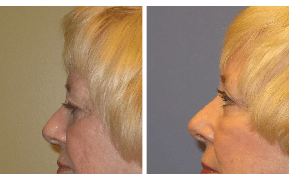 Brow Lift - Case 2 (3)