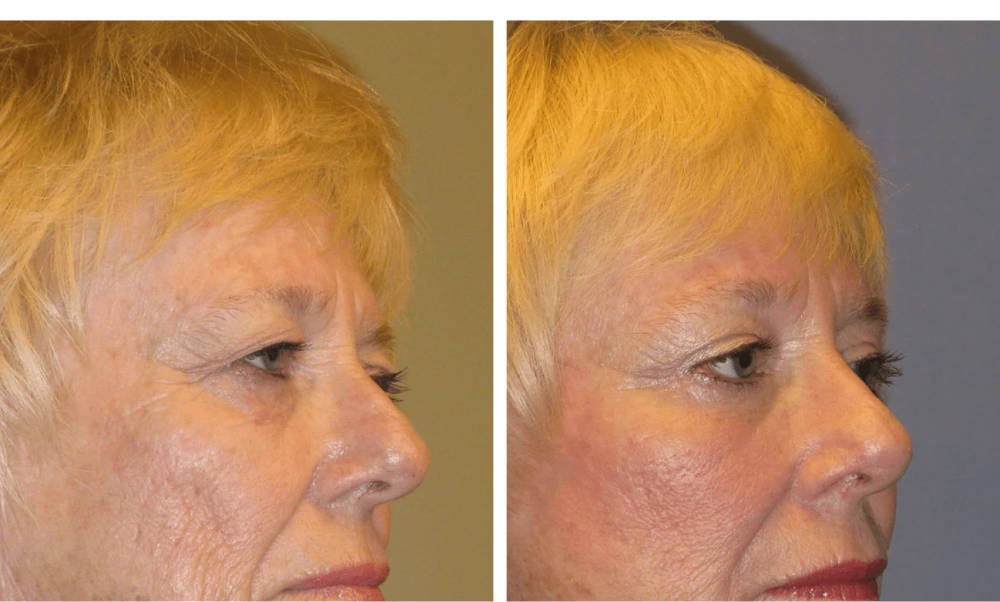 Brow Lift - Case 2