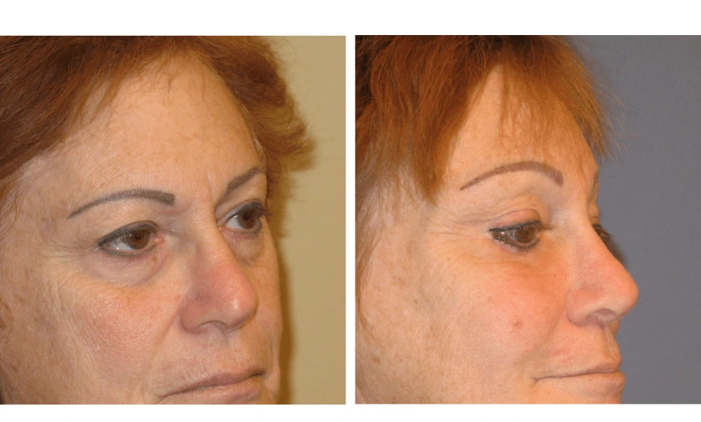 Brow Lift - Case 3 (1)