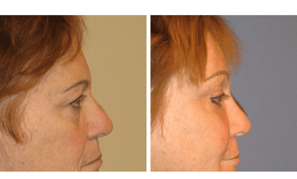 Brow Lift - Case 3 (2)