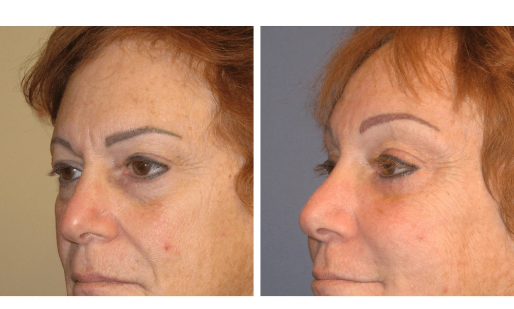 Brow Lift - Case 3 (3)