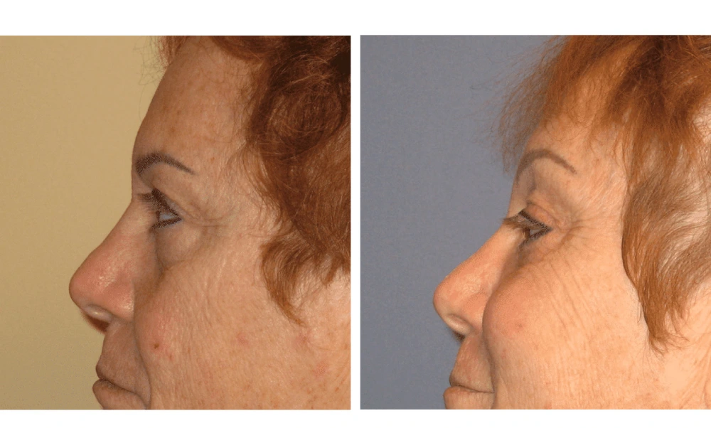 Brow Lift - Case 3 (4)