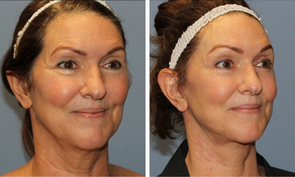 Brow Lift - Case 4 (1)