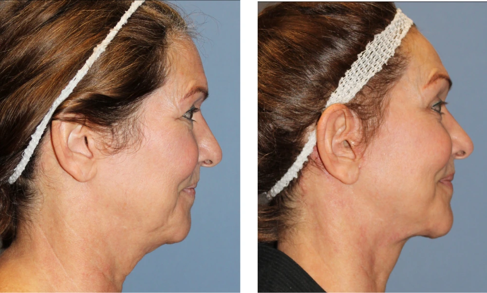 Brow Lift - Case 4 (2)